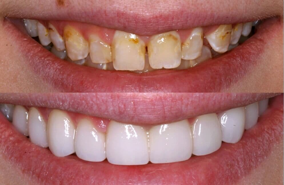 Porcelain Veneers